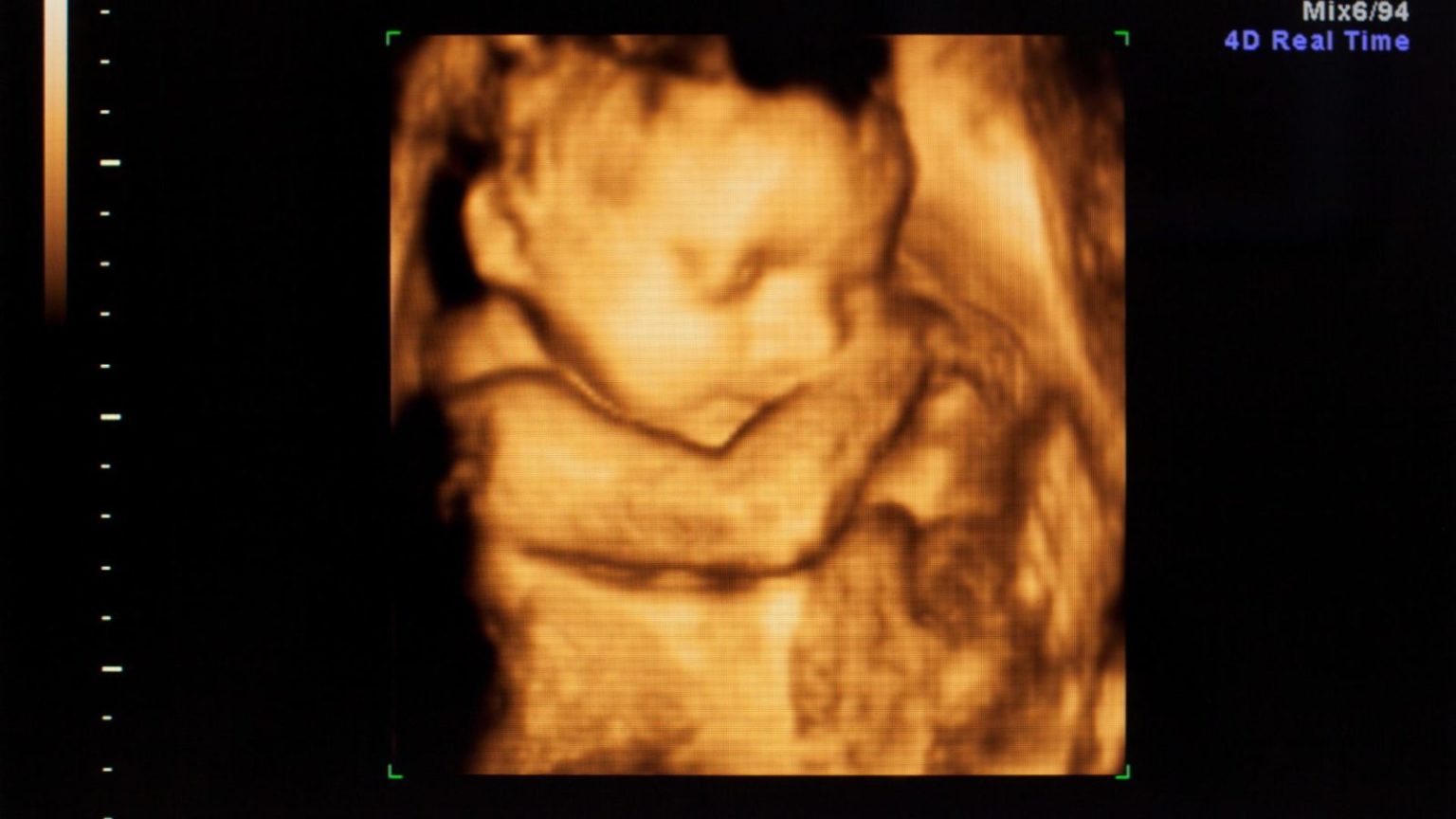 Advantages Of 3d And 4d Ultrasounds